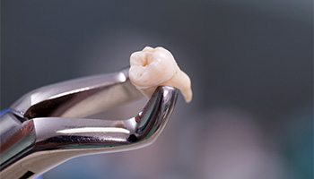 Dental forceps holding an extracted tooth