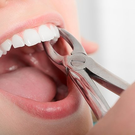 A woman having her tooth extracted with dental forceps