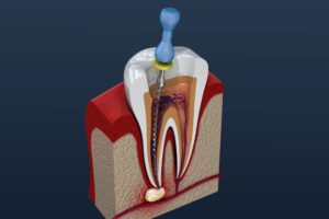 Model of root canal procedure